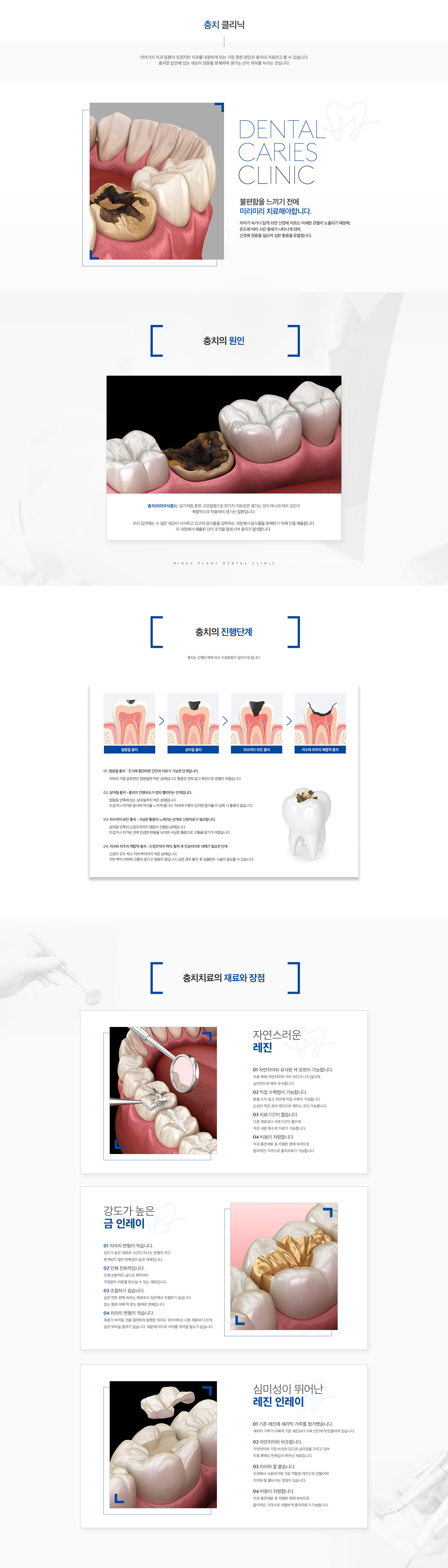 미래플란트치과 충치 치료 단계 및 치료 재료 안내