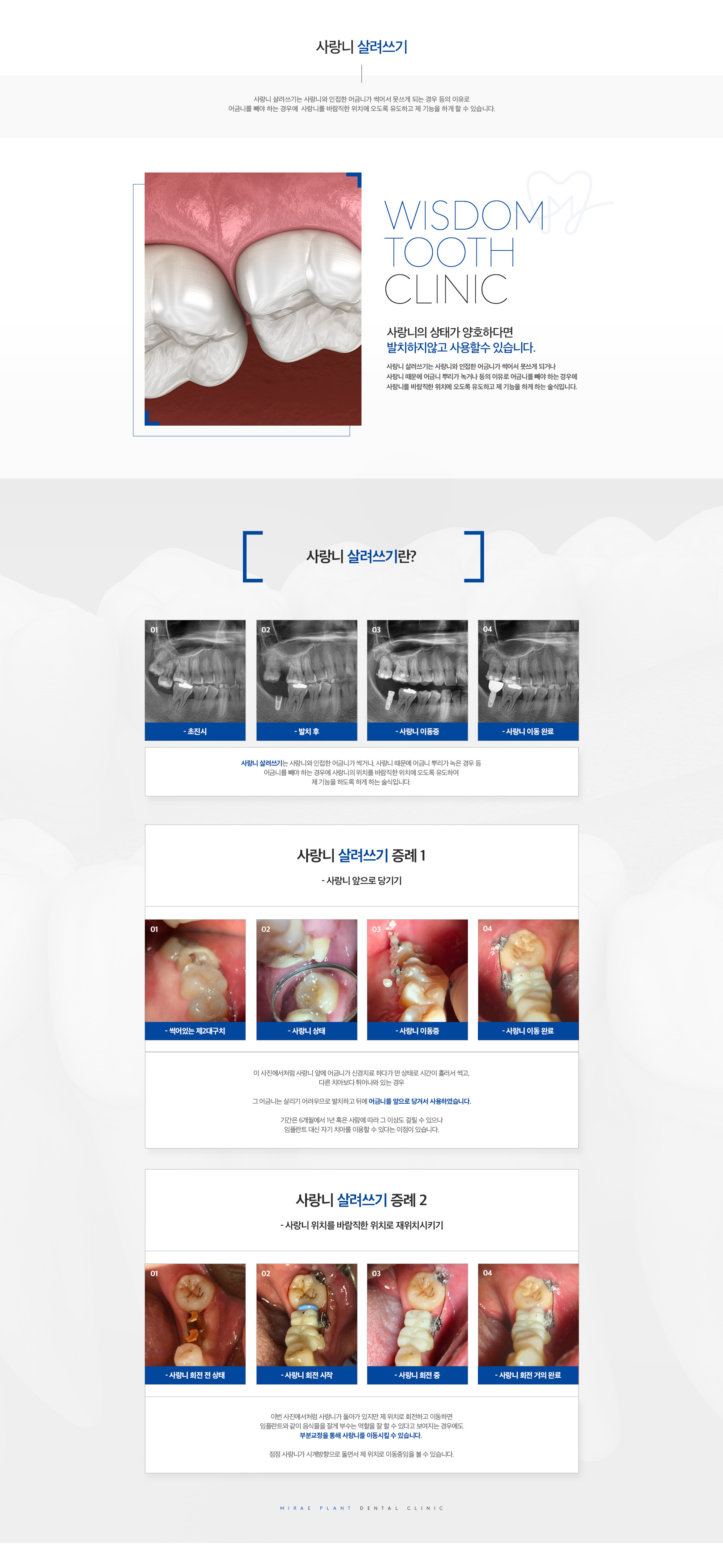 미래플란트치과 사랑니 살려쓰기 안내 - 사랑니를 활용한 치료 방법